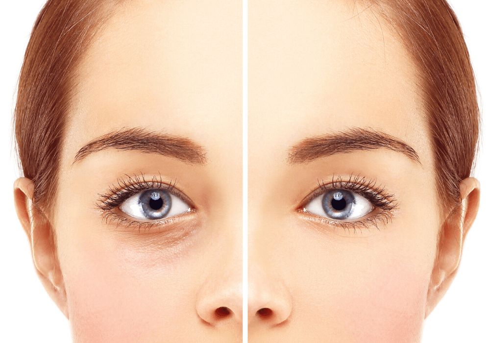 Blefaroplastia